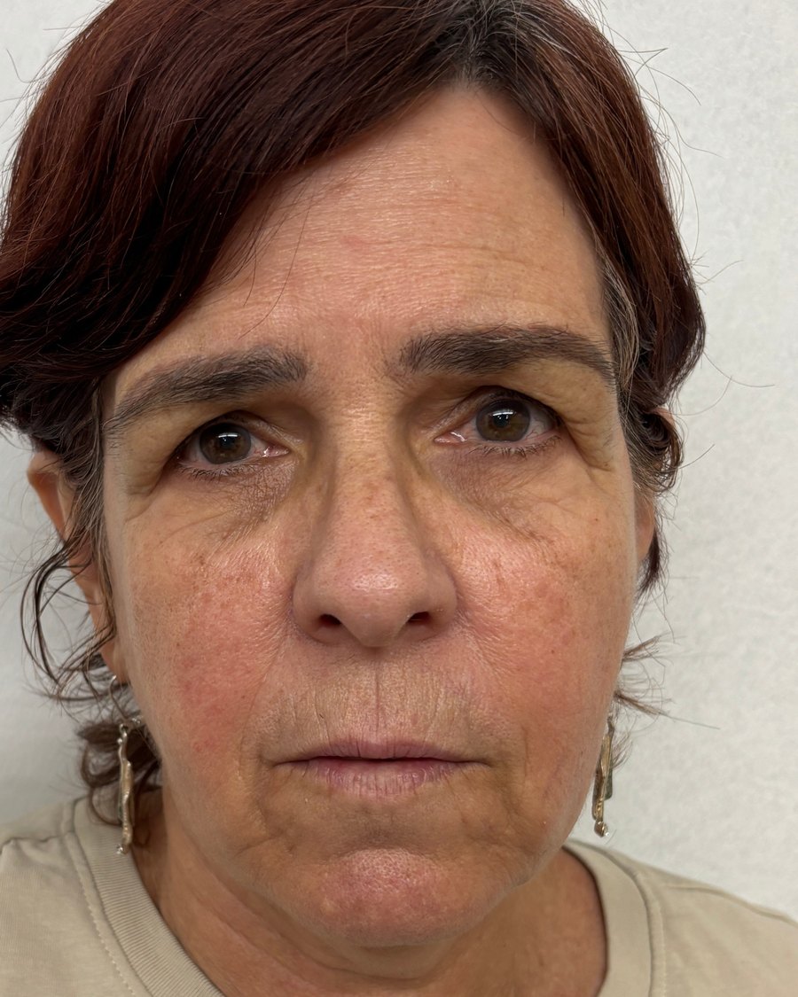 Rostro de la paciente antes de iniciar el protocolo FaceReset