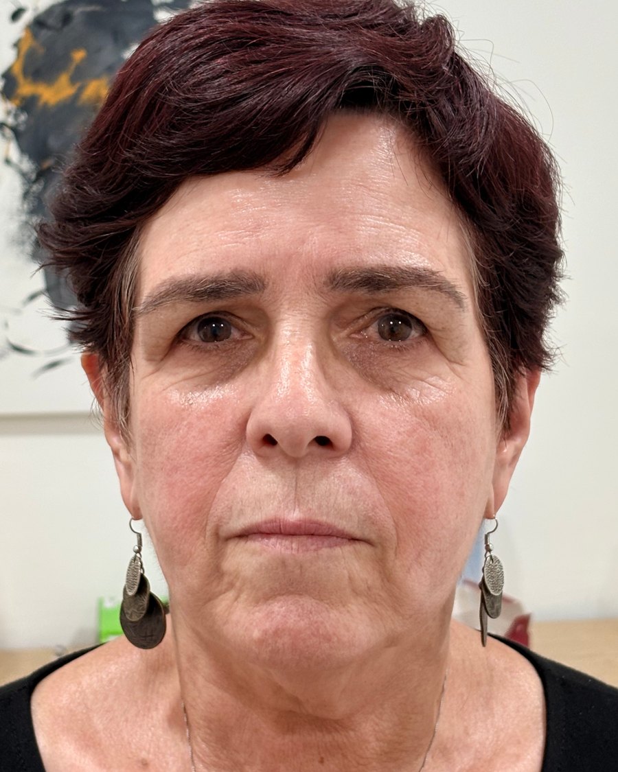 Rostro de la paciente a los tres meses del protocolo FaceReset