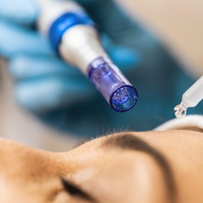 micro needling y producto